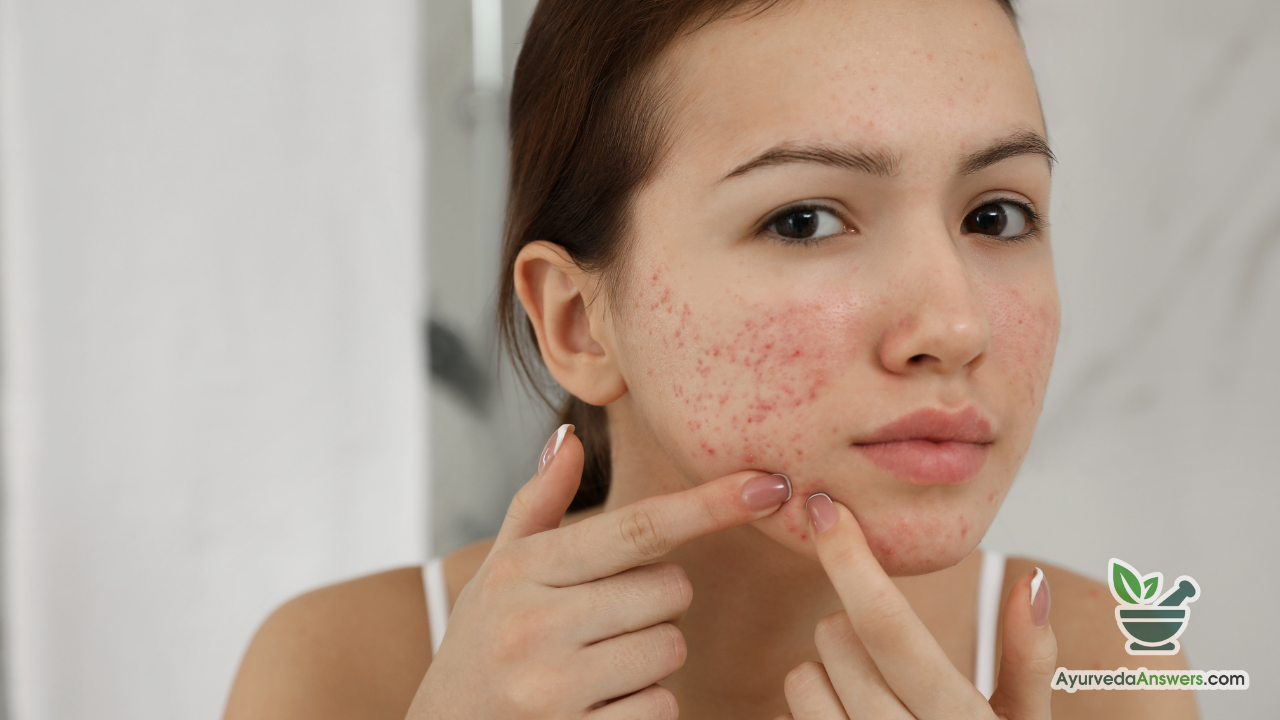 Treating Pigmentation & Acne with Ayurveda